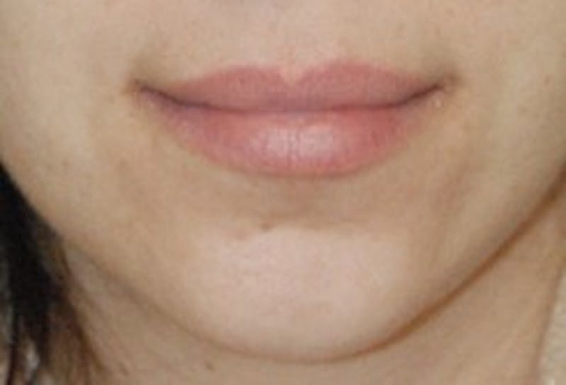 Facial Fillers / Injectables Before & After Gallery - Patient 300448 - Image 1