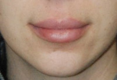 Facial Fillers / Injectables Before & After Gallery - Patient 300448 - Image 2