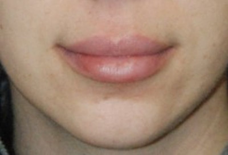 Facial Fillers / Injectables Before & After Gallery - Patient 300448 - Image 2