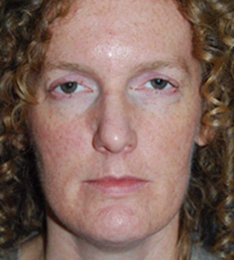 Facial Fillers / Injectables Before & After Gallery - Patient 224962 - Image 1