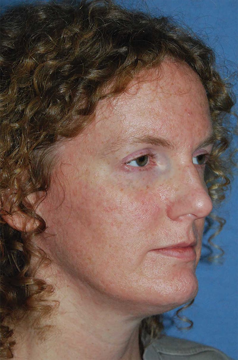 Facial Fillers / Injectables Before & After Gallery - Patient 224962 - Image 3