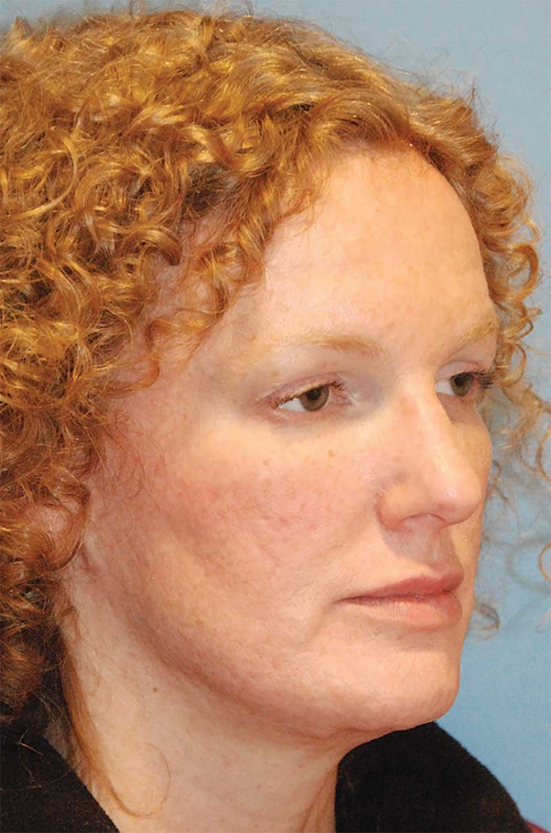Facial Fillers / Injectables Before & After Gallery - Patient 224962 - Image 4