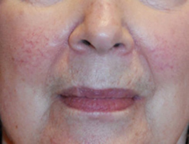 Facial Fillers / Injectables Before & After Gallery - Patient 260157 - Image 1