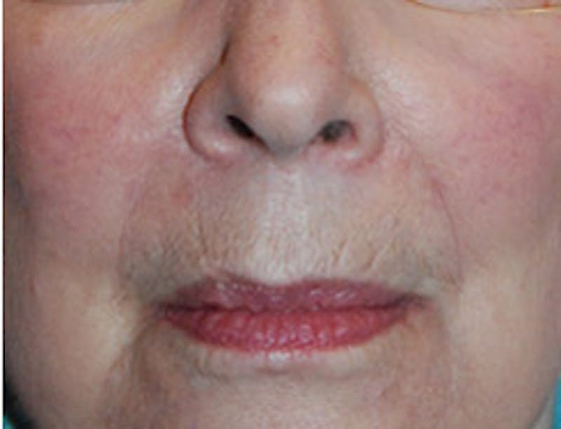 Facial Fillers / Injectables Before & After Gallery - Patient 260157 - Image 2