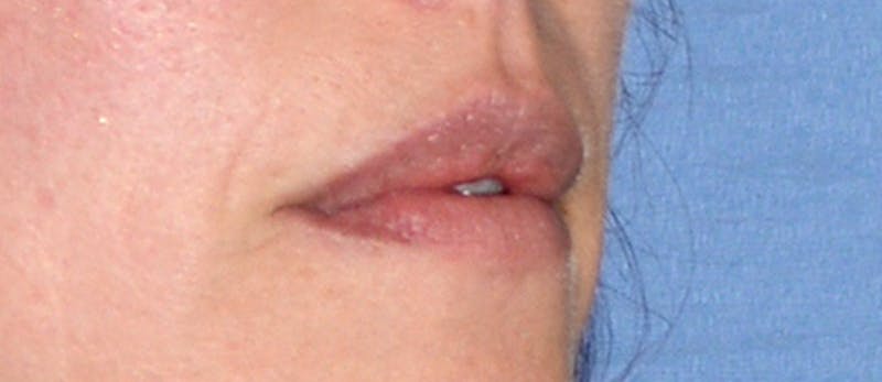 Facial Fillers / Injectables Before & After Gallery - Patient 917564 - Image 1