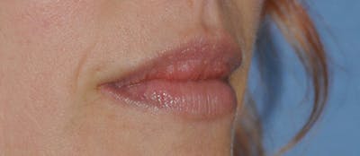 Facial Fillers / Injectables Before & After Gallery - Patient 917564 - Image 2