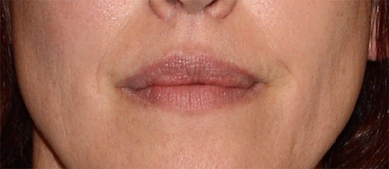 Facial Fillers / Injectables Before & After Gallery - Patient 917564 - Image 3
