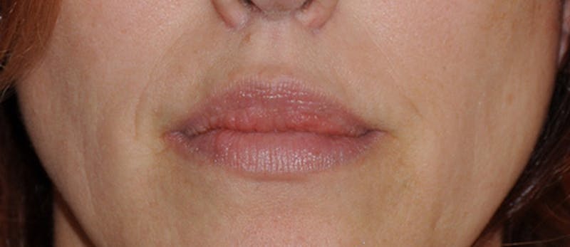 Facial Fillers / Injectables Before & After Gallery - Patient 917564 - Image 4