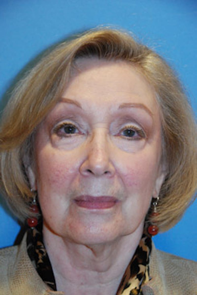 Facial Fillers / Injectables Before & After Gallery - Patient 339066 - Image 1
