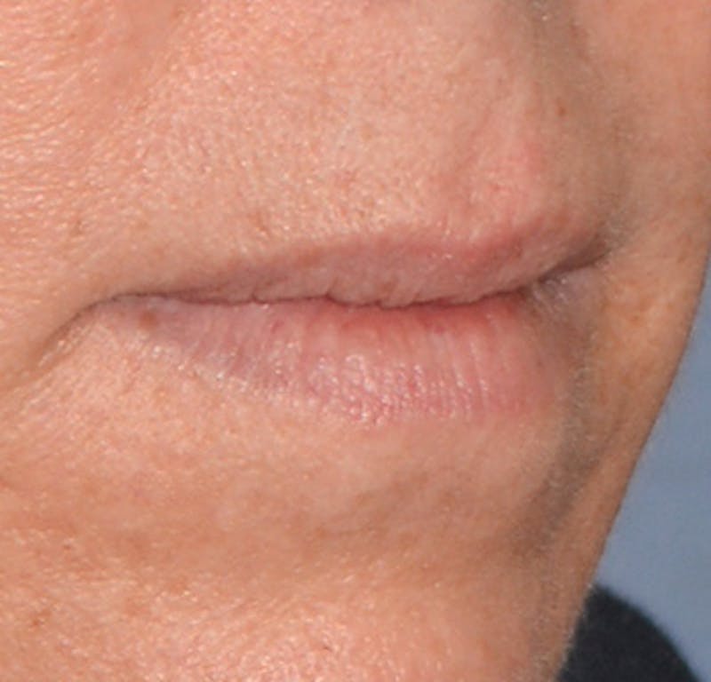 Facial Fillers / Injectables Before & After Gallery - Patient 255983 - Image 3