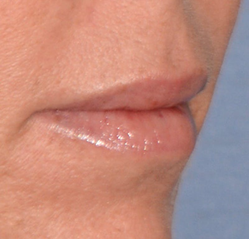 Facial Fillers / Injectables Before & After Gallery - Patient 255983 - Image 4