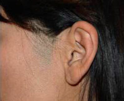 Laser Hair Removal Before & After Gallery - Patient 335789 - Image 1