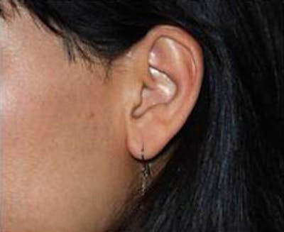 Laser Hair Removal Before & After Gallery - Patient 335789 - Image 2
