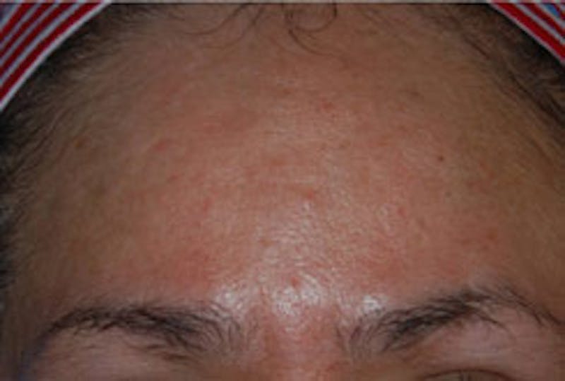 Laser Resurfacing Before & After Gallery - Patient 270611 - Image 1