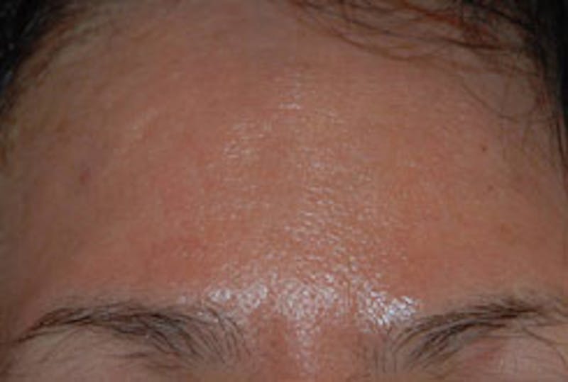 Laser Resurfacing Before & After Gallery - Patient 270611 - Image 2