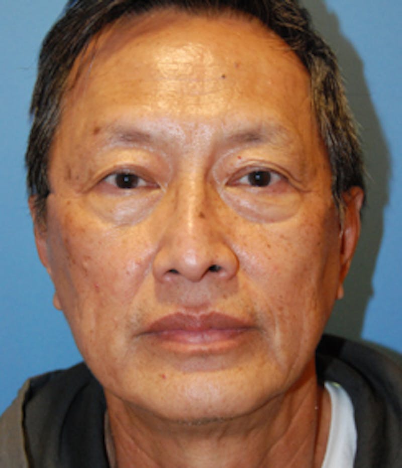 Laser Resurfacing Before & After Gallery - Patient 256354 - Image 1