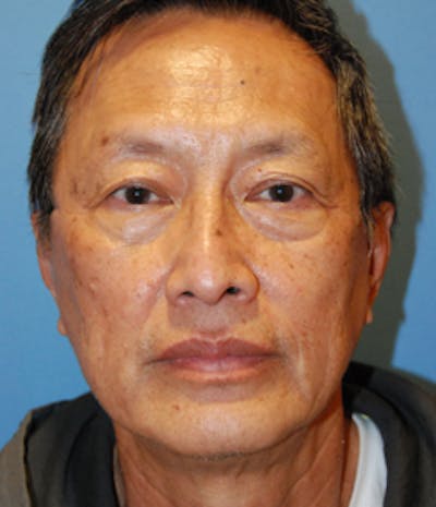 Laser Resurfacing Before & After Gallery - Patient 256354 - Image 1