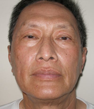 Laser Resurfacing Before & After Gallery - Patient 256354 - Image 2
