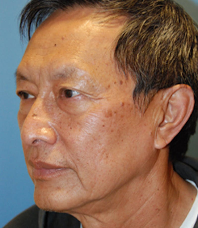 Laser Resurfacing Before & After Gallery - Patient 256354 - Image 3