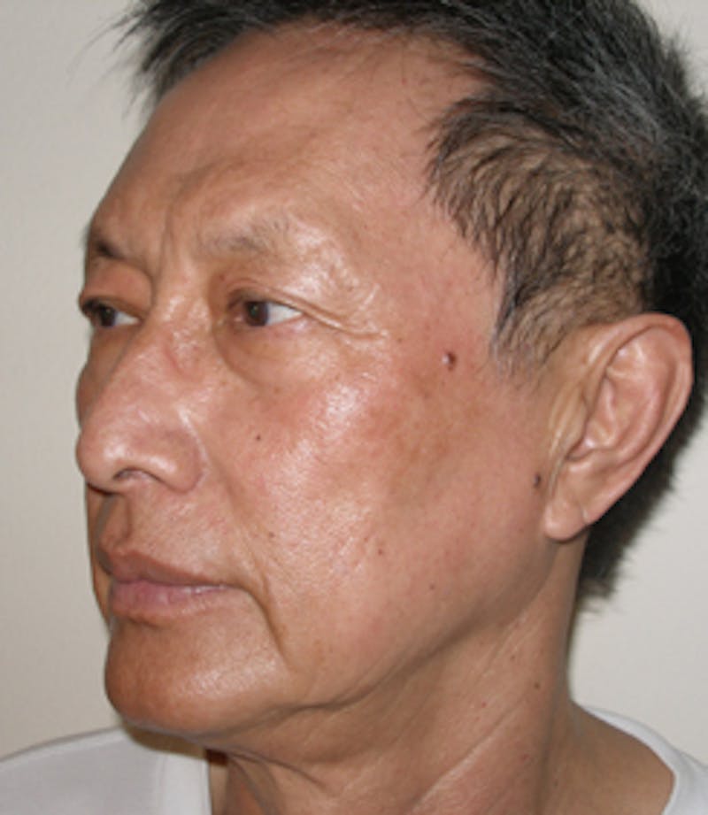 Laser Resurfacing Before & After Gallery - Patient 256354 - Image 4