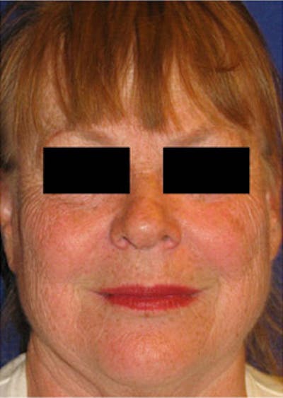 Laser Resurfacing Before & After Gallery - Patient 986474 - Image 1