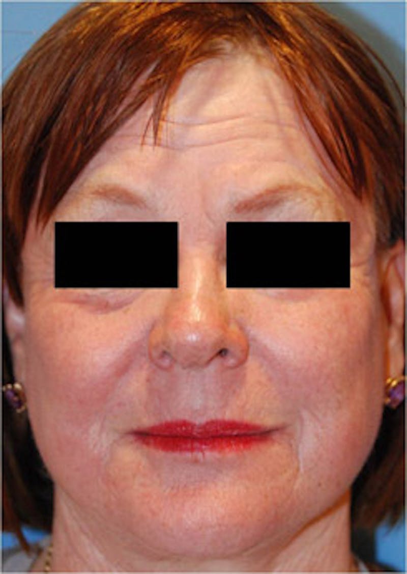 Laser Resurfacing Before & After Gallery - Patient 986474 - Image 2