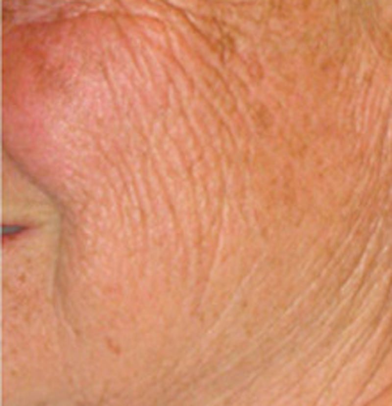 Laser Resurfacing Before & After Gallery - Patient 371674 - Image 1