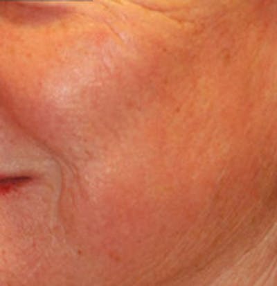 Laser Resurfacing Before & After Gallery - Patient 371674 - Image 2
