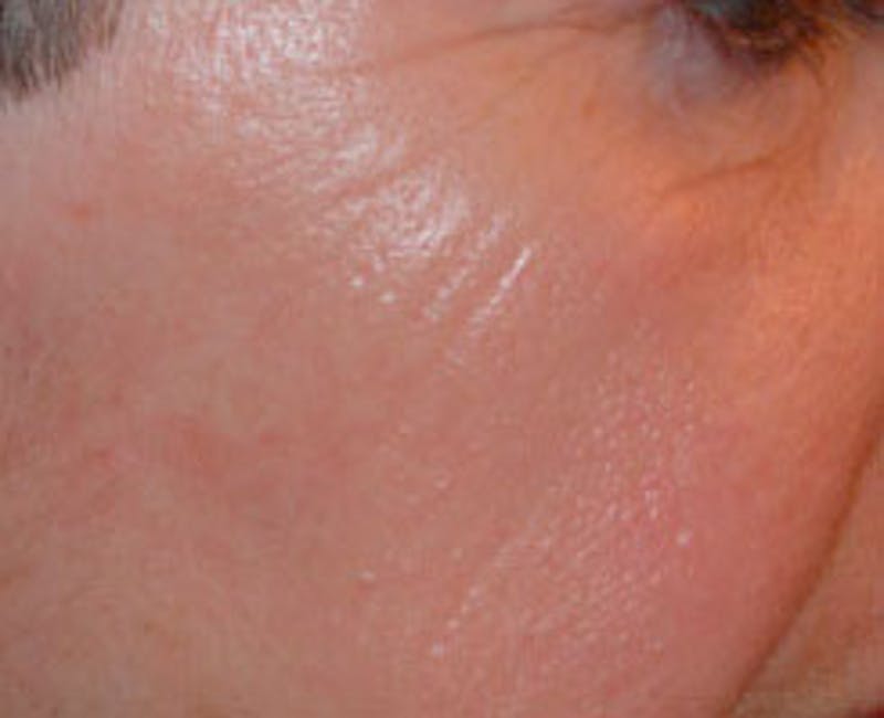 Laser Resurfacing Before & After Gallery - Patient 255202 - Image 1