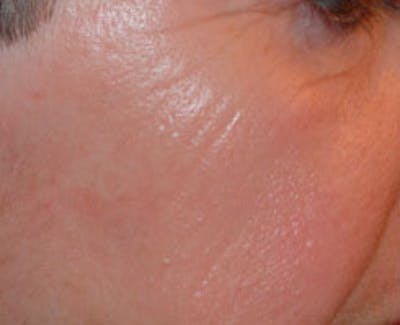 Laser Resurfacing Before & After Gallery - Patient 255202 - Image 1