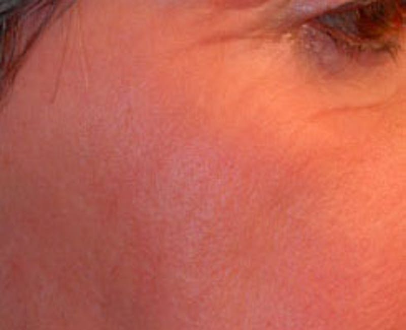 Laser Resurfacing Before & After Gallery - Patient 255202 - Image 2