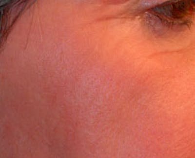 Laser Resurfacing Before & After Gallery - Patient 255202 - Image 2