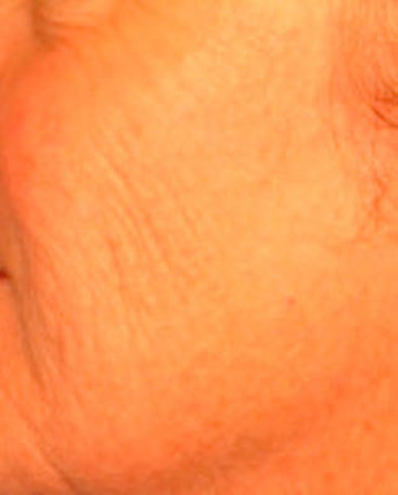 Laser Resurfacing Before & After Gallery - Patient 255202 - Image 3
