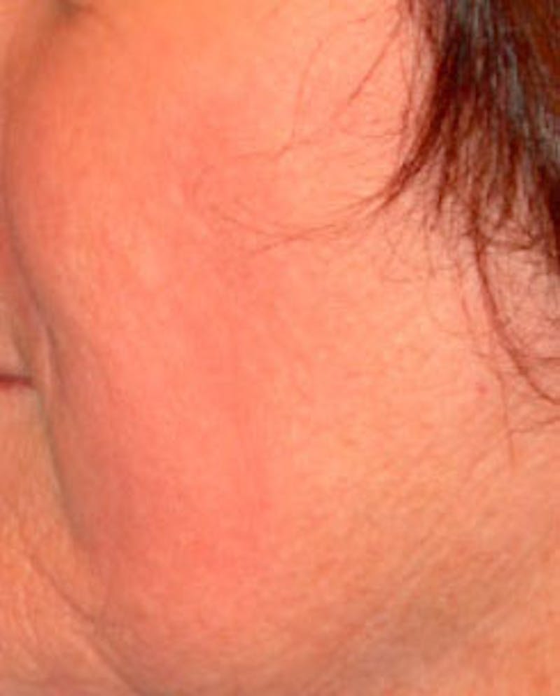 Laser Resurfacing Before & After Gallery - Patient 255202 - Image 4