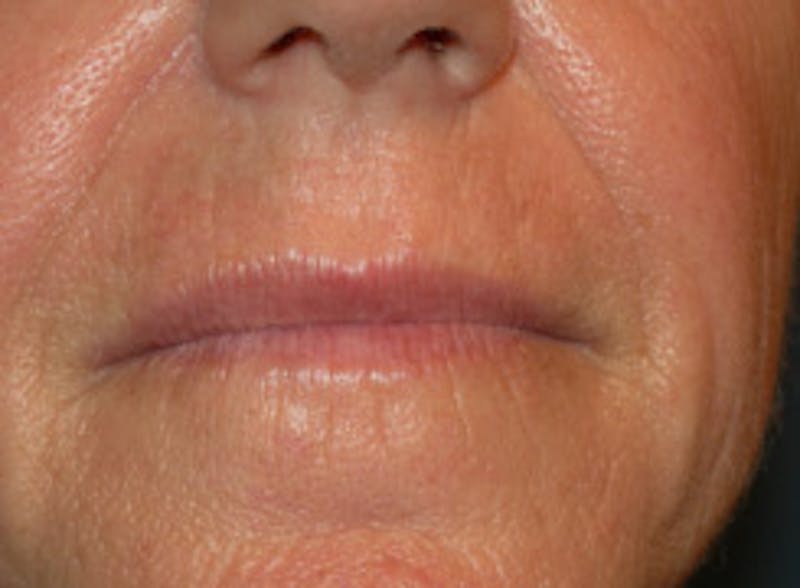 Laser Resurfacing Before & After Gallery - Patient 329533 - Image 1