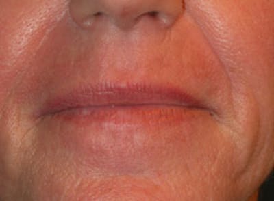 Laser Resurfacing Before & After Gallery - Patient 329533 - Image 2