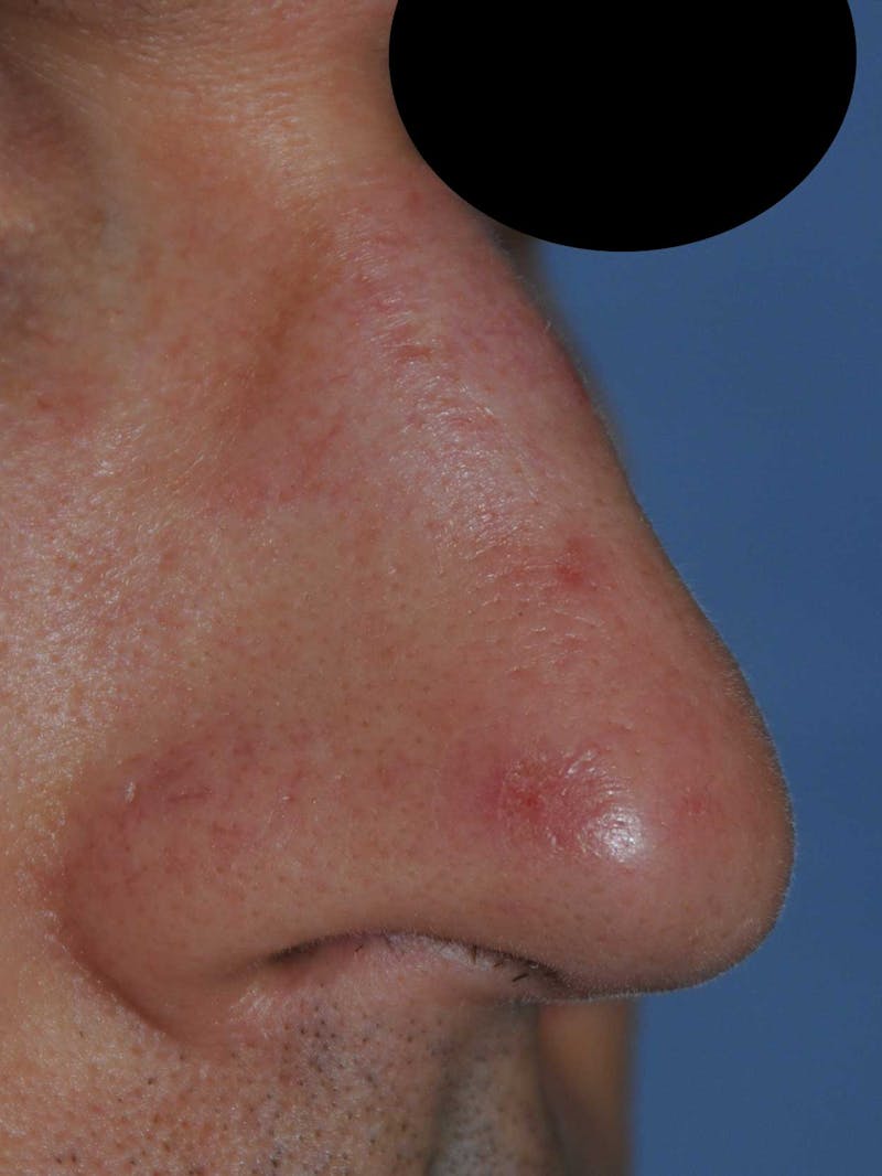 Laser Resurfacing Before & After Gallery - Patient 266586 - Image 1