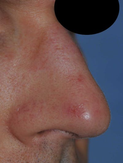 Laser Resurfacing Before & After Gallery - Patient 266586 - Image 1