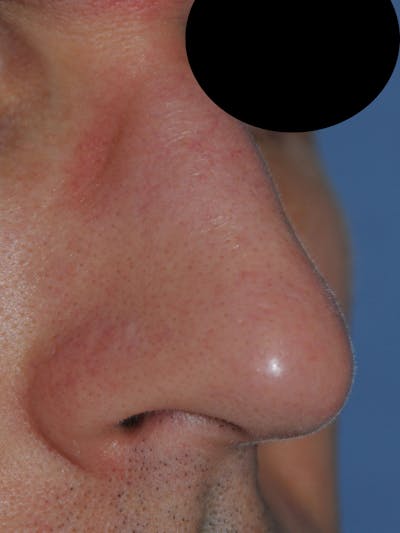 Laser Resurfacing Before & After Gallery - Patient 266586 - Image 2