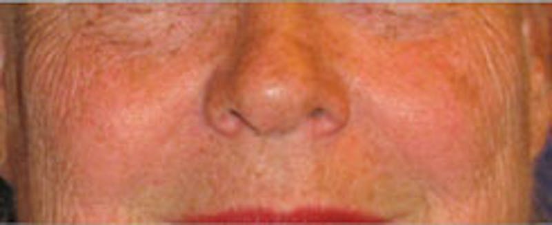 Laser Resurfacing Before & After Gallery - Patient 986149 - Image 1
