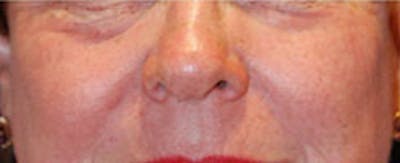 Laser Resurfacing Before & After Gallery - Patient 986149 - Image 2