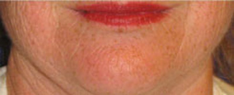 Laser Resurfacing Before & After Gallery - Patient 986149 - Image 3