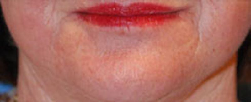 Laser Resurfacing Before & After Gallery - Patient 986149 - Image 4