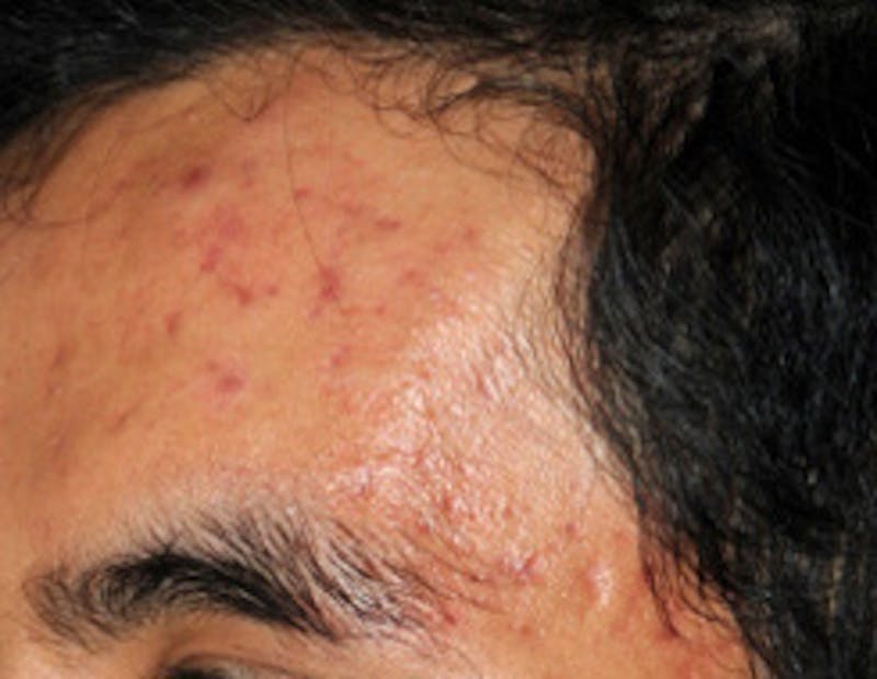 Microdermabrasion Before & After Gallery - Patient 215862 - Image 1