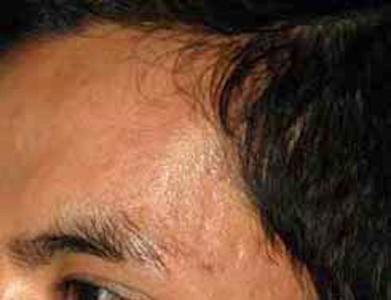 Microdermabrasion Before & After Gallery - Patient 215862 - Image 2