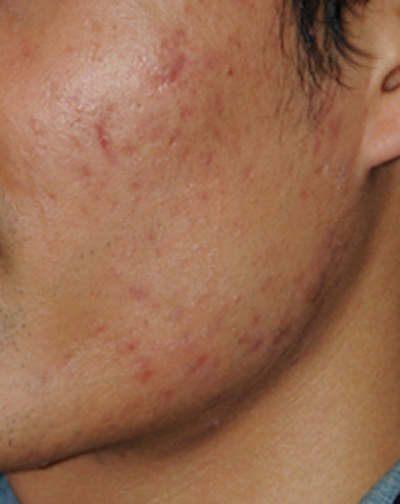 Microdermabrasion Before & After Gallery - Patient 215862 - Image 3