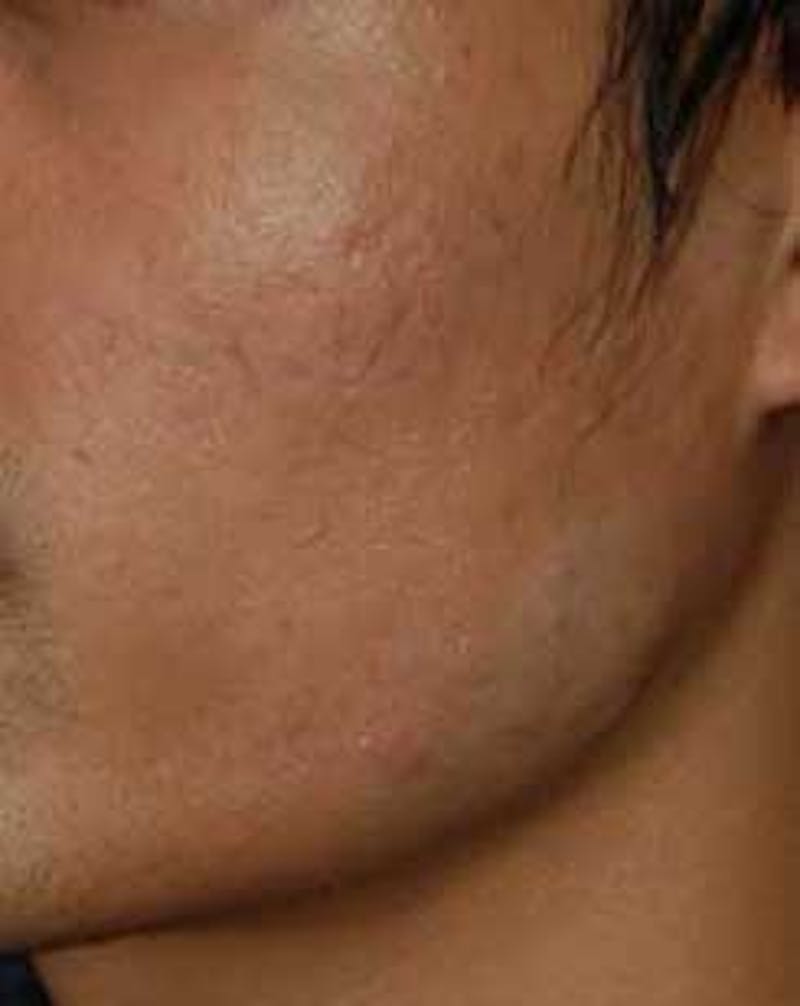 Microdermabrasion Before & After Gallery - Patient 215862 - Image 4