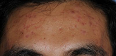 Intense Pulse Light Before & After Gallery - Patient 399573 - Image 1