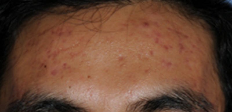 Intense Pulse Light Before & After Gallery - Patient 399573 - Image 1