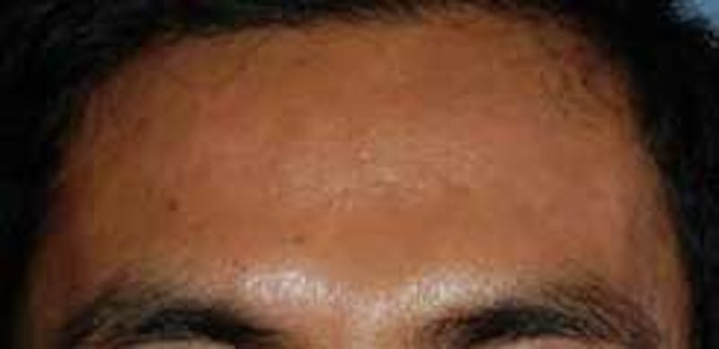 Intense Pulse Light Before & After Gallery - Patient 399573 - Image 2